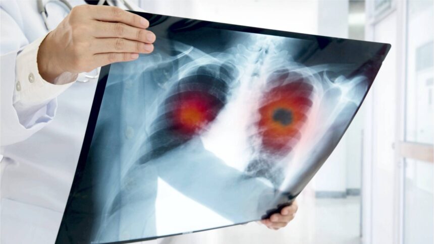 泰北肺癌高发 平均每天新增7例死亡5例